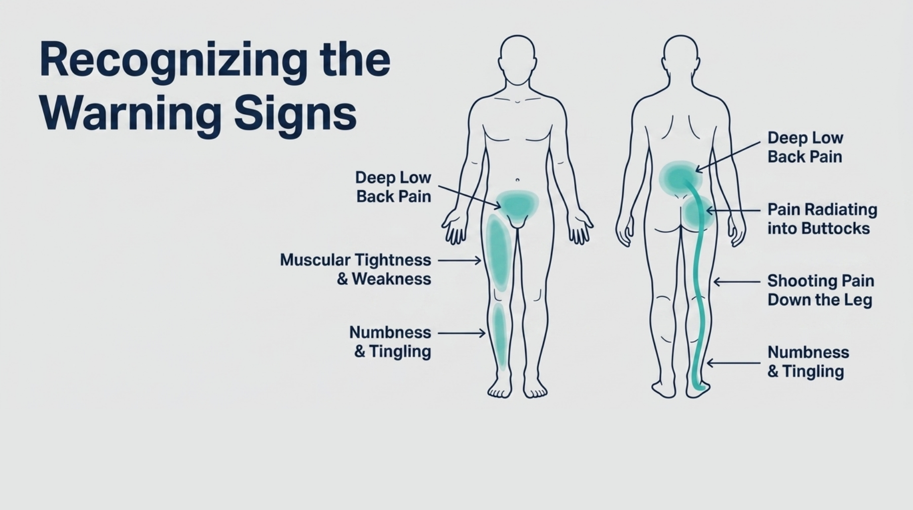 Herniated Disc and Sciatica: Can Spinal Decompression Help?